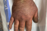 En las mordeduras de la mano hay que retirar, de manera inmediata, anillos y pulseras. La hinchazón puede ser grande en tan sólo cinco horas. 