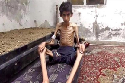 Desnutrición 8Manifestantes con la imagen de un niño, supuestamente de Madaya, en una protesta en Beirut. A la derecha, una foto distribuida por el Consejo Revolucionario de Madaya.-EFE / NABIL MOUNZER - CONSEJO REVOLUCIONARIO MADAYA / AP