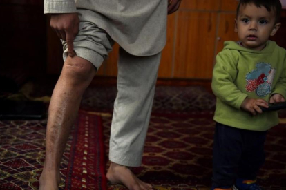 Mohammed muestra sus cicatrices junto a Zamir, su hijo menor.-WAKIL KOHSAR