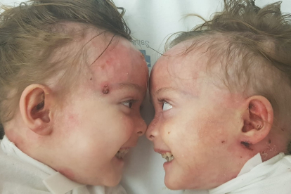 Carla y Noa son dos gemelas de Madrid afectadas por la enfermedad de Piel de Mariposa. Fotos facilitadas por DEBRA