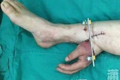 Los cirujanos injertaron la mano en su pierna para mantener el flujo sanguineo.-Foto: CANAL DE TV XXCB