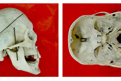 Cráneo sinostótico con pronunciada dolicocefalia (Museo Nacional de Praga)/E. Bruner.