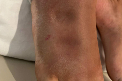 Imagen de la herida que produce una mordedura de víbora en el pie.