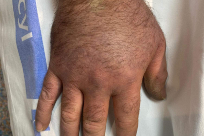 Imagen de la inflamación de una mordedura de víbora en la mano