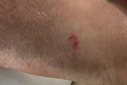 Imagen de la herida que produce una mordedura de víbora en su fase inicial.