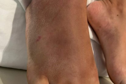 Imagen de la herida que produce una mordedura de víbora en el pie.