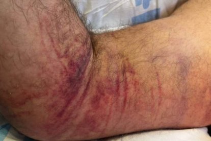 A veces la inflamación por mordedura de víbora se extiende por el brazo como en la imagen.