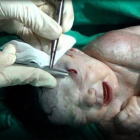 El bebé en la operación para extraerle el pedazo de metralla.-