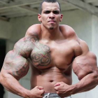 Romario Dos Santos puso en riesgo su vida al inyectarse durante años Synthol y alcohol en sus bíceps-