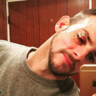 Àlex Casademunt muestra su rostro con múltiples heridas, tras sufrir una agresión el pasado 15 de enero en una discoteca de Vigo-INSTAGRAM