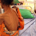 Una niña de 12 años con altos niveles de desnutrición en Yemen.-AFP