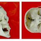 Cráneo sinostótico con pronunciada dolicocefalia (Museo Nacional de Praga)/E. Bruner.