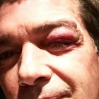 El actor Antonio Banderas, con el ojo morado.-INSTAGRAM