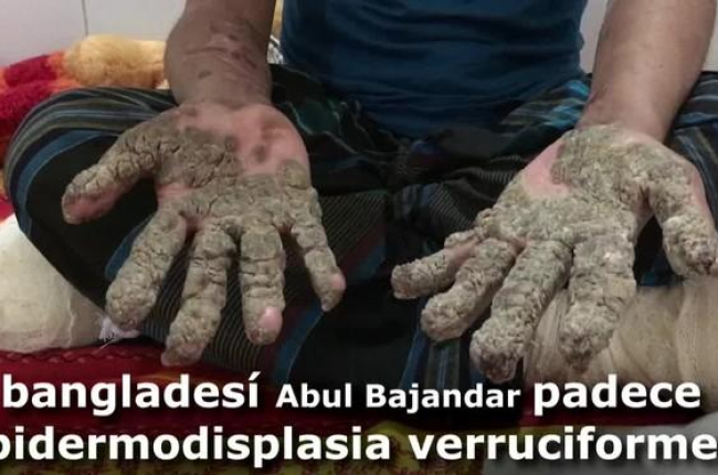Abul Bajandar se hizo mundialmente conocido por las grandes verrugas que cubrían su cuerpo y que le llevaron a ingresar hace hoy dos años en un hospital de Dacca.-EFE