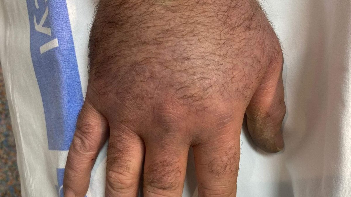 En las mordeduras de la mano hay que retirar, de manera inmediata, anillos y pulseras. La hinchazón puede ser grande en tan sólo cinco horas. 