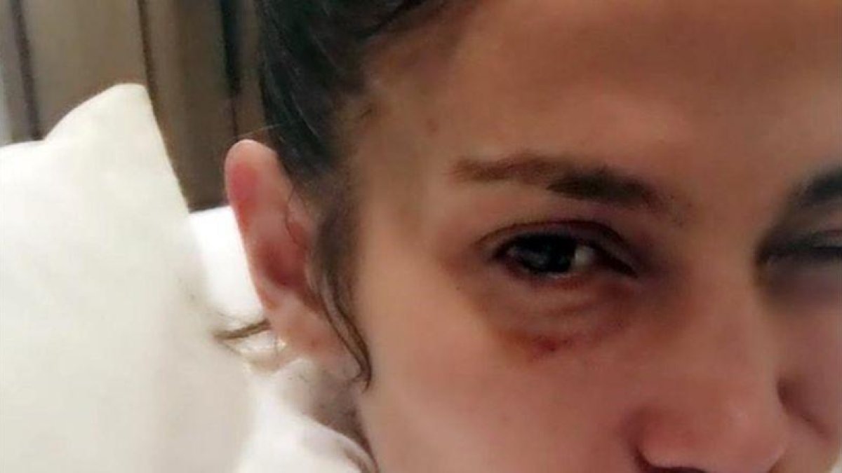 Jennifer Lopez, con el ojo morado.-INSTAGRAM