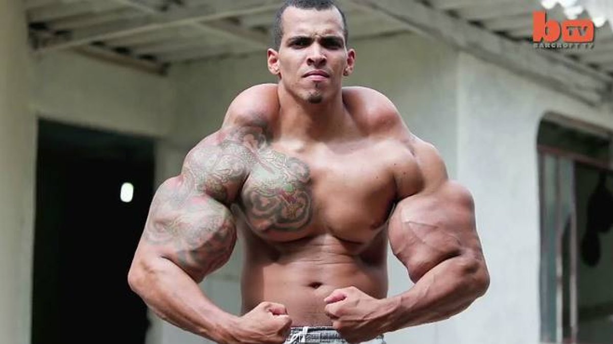 Romario Dos Santos puso en riesgo su vida al inyectarse durante años Synthol y alcohol en sus bíceps-