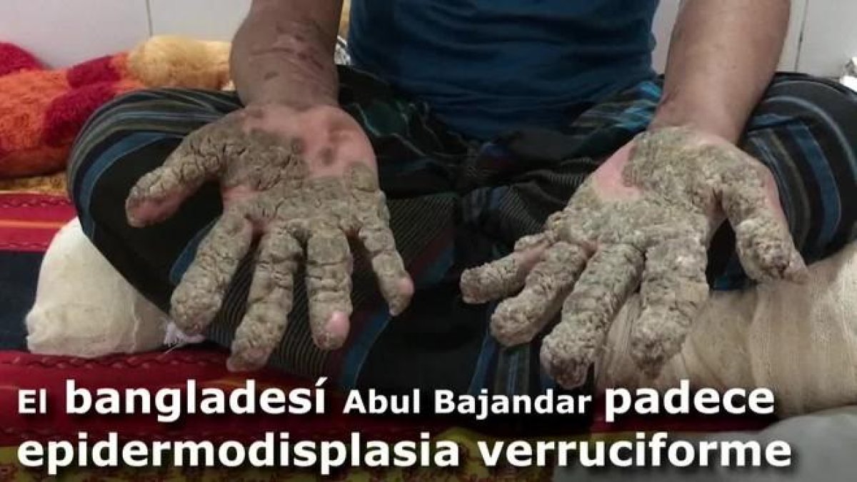 Abul Bajandar se hizo mundialmente conocido por las grandes verrugas que cubrían su cuerpo y que le llevaron a ingresar hace hoy dos años en un hospital de Dacca.-EFE