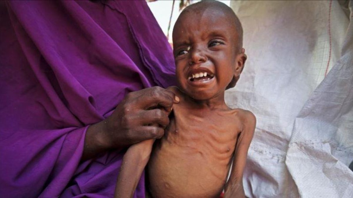 Un niño somalí de 7 años que padece malnutrición en el campo de desplazados de Garasbaley, a las afueras de Mogadiscio, la capital de Somalia.-AP / FARAH ABDI WARSAMEH