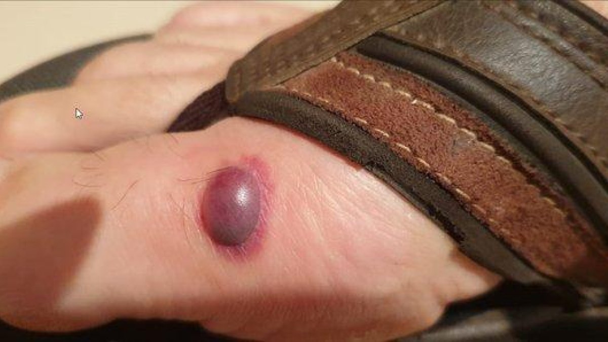 Una de las funcionarias afectadas por picaduras de chinches en la prisión de Valdemoro muestra esta ampolla en uno de sus pies.-N.G.