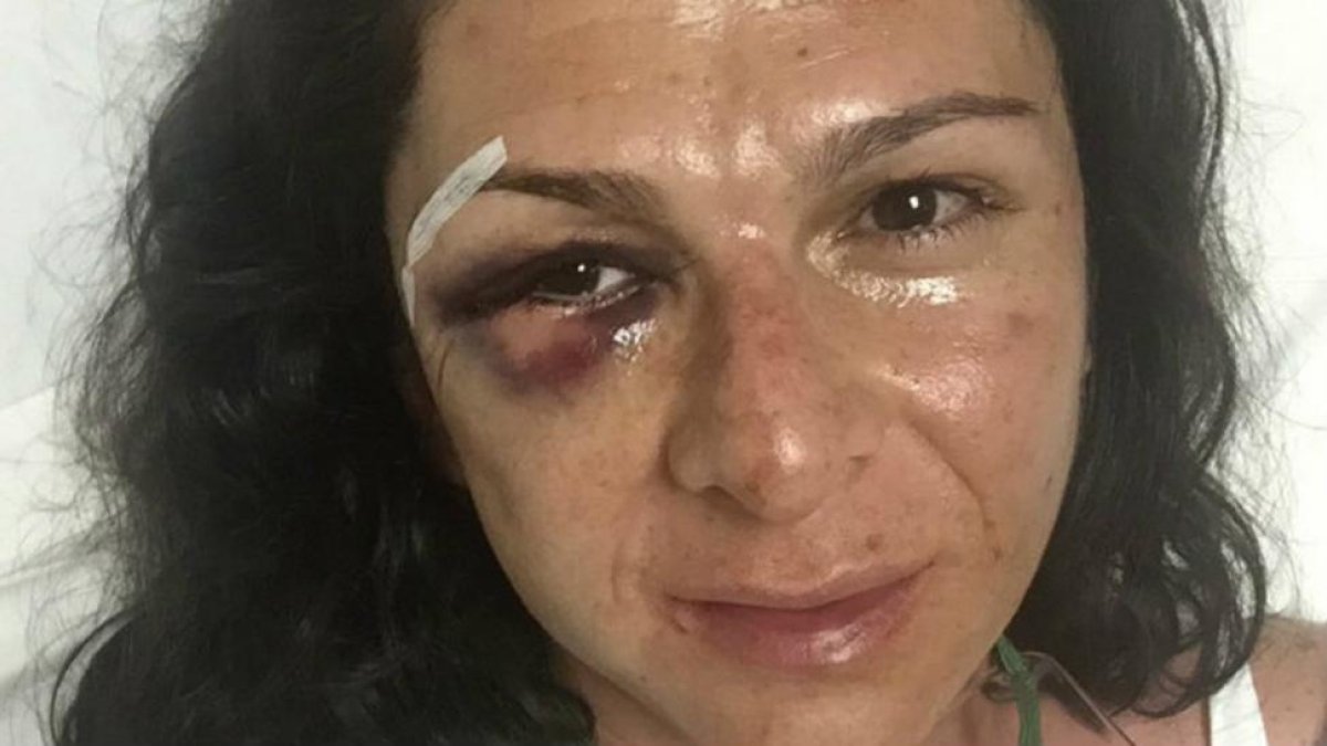 Ana Guevara compartió su herida con esta imagen.-ANA GUEVARA