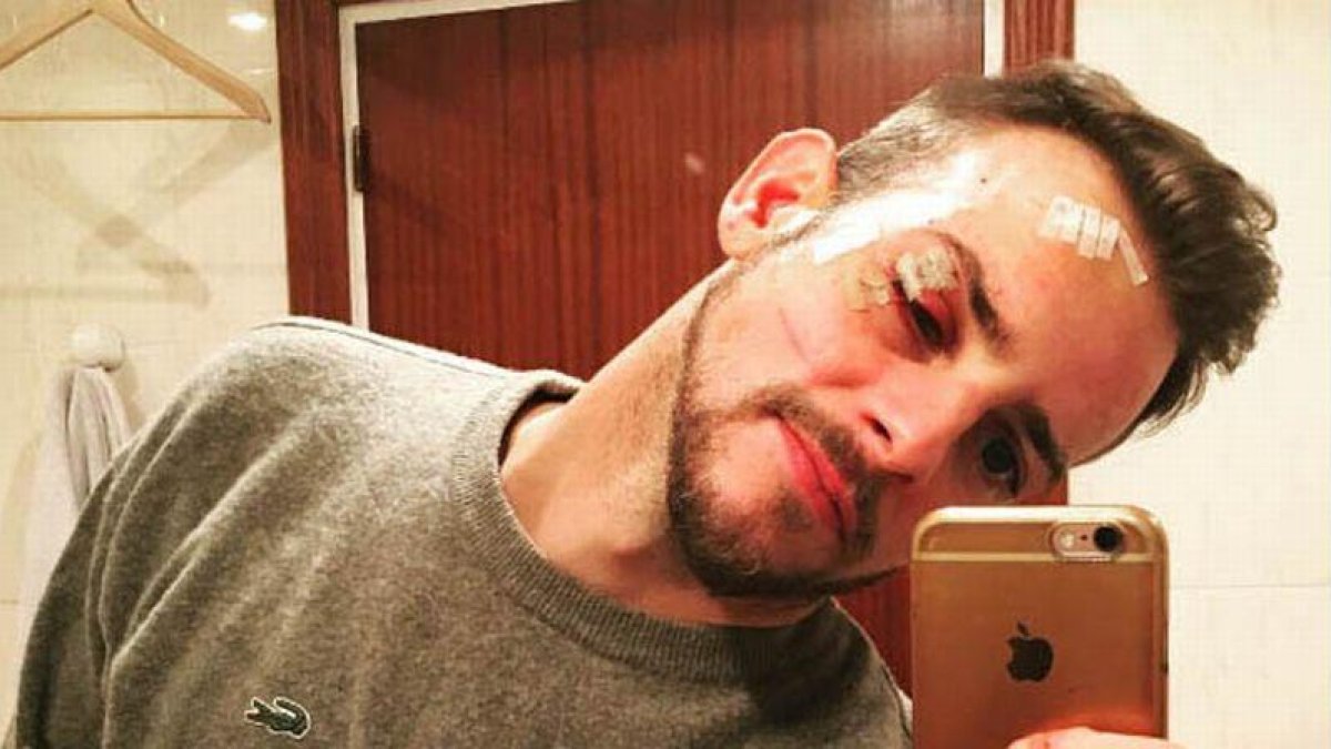 Álex Casademunt publica una foto de su agresión.-