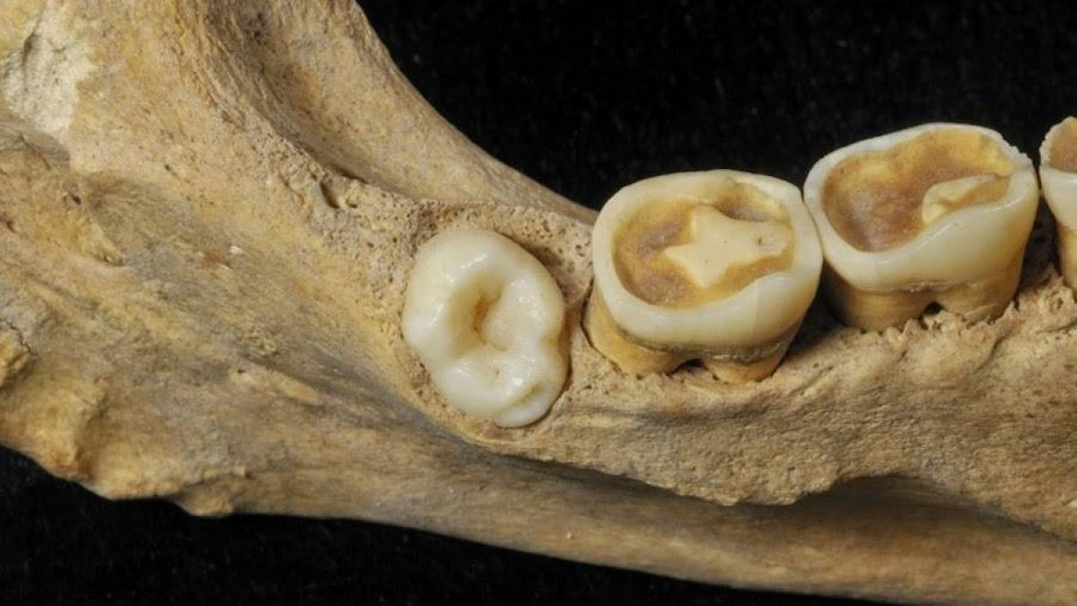Cuarto molar localizado en la mandíbula extraída de uno de los enterramientos colectivos de El Mirador.-IPHES