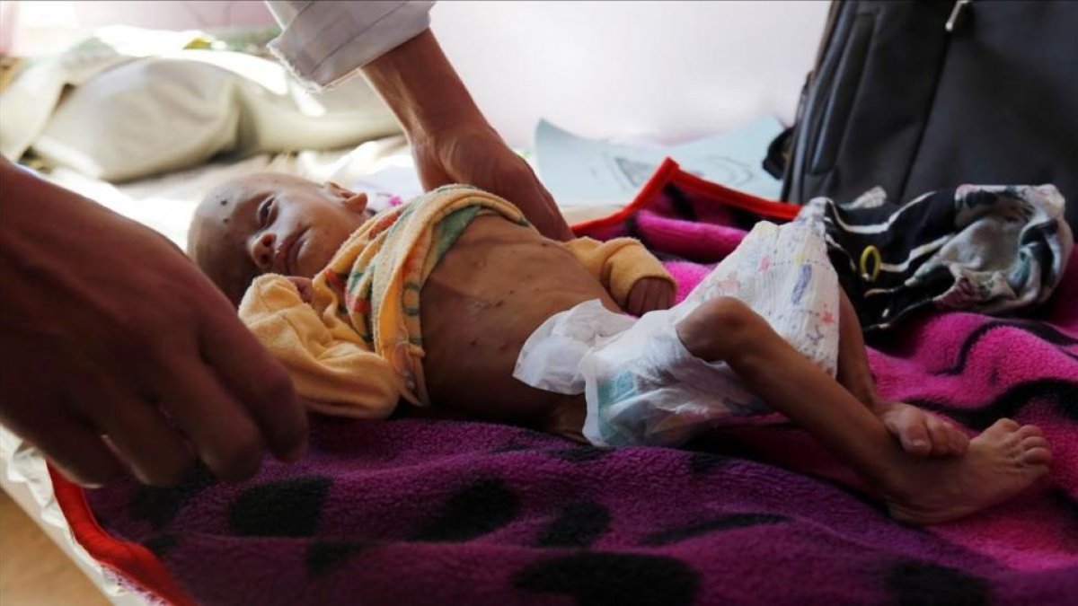 Un niño que sufre de desnutrición recibe tratamiento en un hospital de Saná, el 24 de noviembre.-/ EFE / YAHYA ARHAB