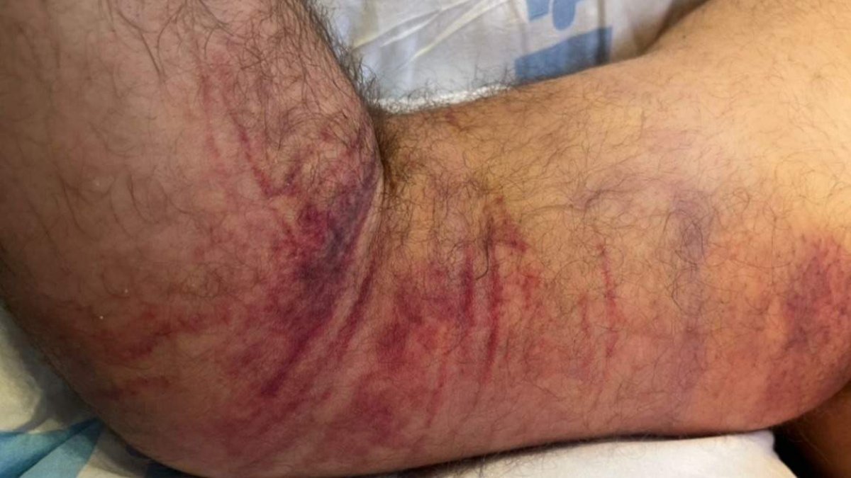 Aunque la mordedura haya sido en la mano, la infección puede alcanzar a todo el brazo como el de la imagen. El caso más grave se da cuando llega al tronco.