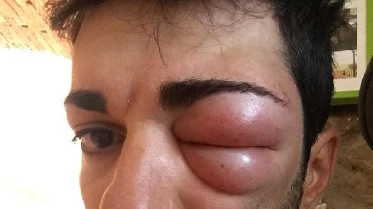 Danilo Cela tras la picada de un insecto-/ PERIODICO