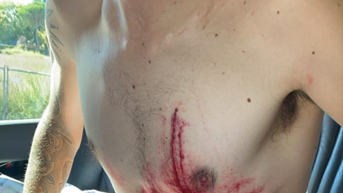 Madrazo compartió en redes sociales las secuelas del accidente. TWITTER / @ANGEL MADRAZO