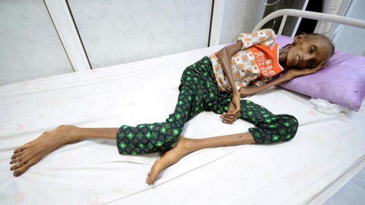 La joven Saida Ahmed Baghili, de 18 años, es atendida en el hospital de Al-Thawra, de la ciudad yemení de Hodeidah, de su severa malnutrición.-REUTERS / ABDULJABBAR ZEYAD
