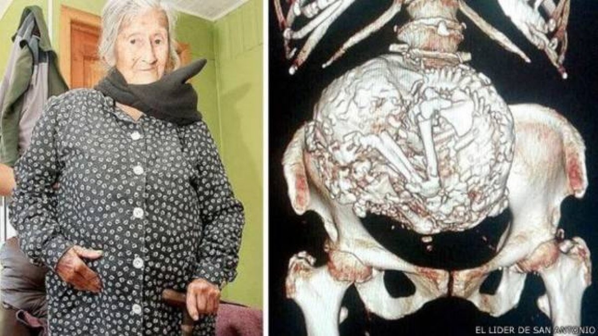 Al hacerle una radiografía a Estela, apareció una imagen que es propia de la columna vertebral de un feto.-Foto: EL LÍDER DE SAN ANTONIO