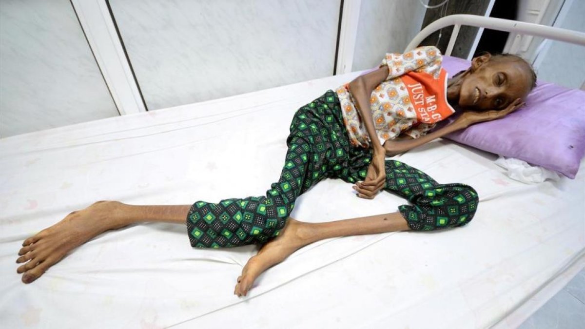La joven Saida Ahmed Baghili, de 18 años, es atendida en el hospital de Al-Thawra, de la ciudad yemení de Hodeidah, de su severa malnutrición.-REUTERS / ABDULJABBAR ZEYAD