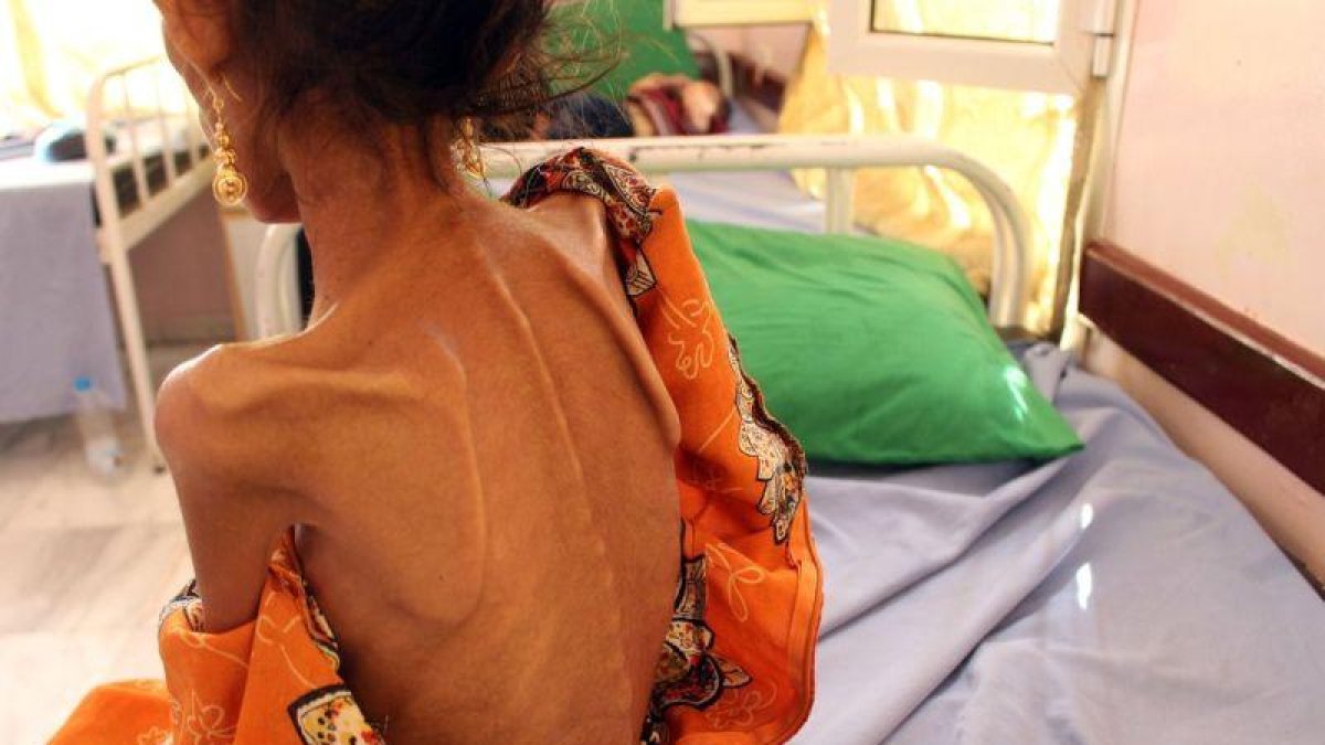Una niña de 12 años con altos niveles de desnutrición en Yemen.-AFP