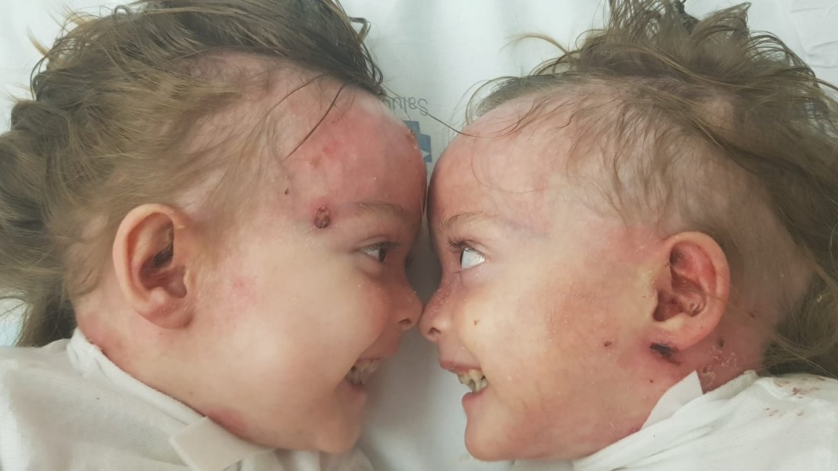 Carla y Noa son dos gemelas de Madrid afectadas por la enfermedad de Piel de Mariposa. Fotos facilitadas por DEBRA