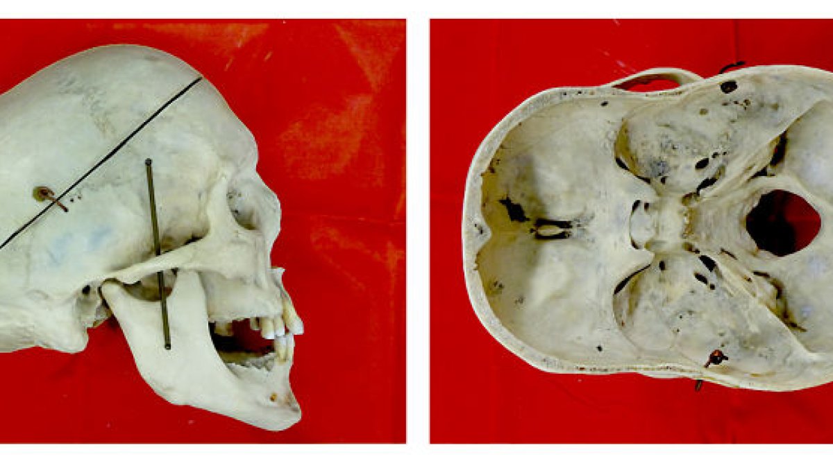 Cráneo sinostótico con pronunciada dolicocefalia (Museo Nacional de Praga)/E. Bruner.