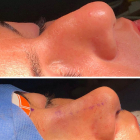 Imagen del antes y el después de la operación en la nariz.-ECB