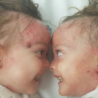 Carla y Noa son dos gemelas de Madrid afectadas por la enfermedad de Piel de Mariposa. Fotos facilitadas por DEBRA